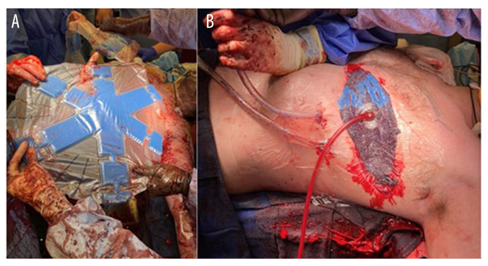 (A) Placement of the modified ABTHERA ADVANCE™ Open Abdomen Dressing, (B) left thoracostomy tubes for temporary chest closure.