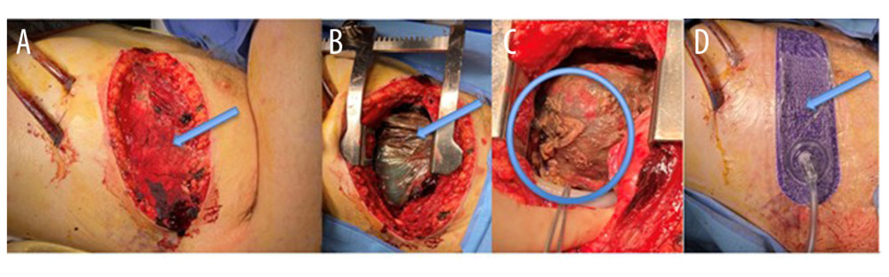 Second-look thoracotomy. (A) Laparotomy packs (arrow), (B) Visceral Protective Layer (arrow), (C) intact cardiac repair (circle), (D) 3M™ Prevena™ Peel and Place Dressing (arrow).