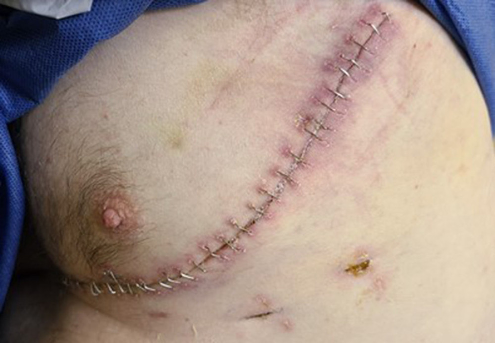 Post-operative left thoracotomy incision.