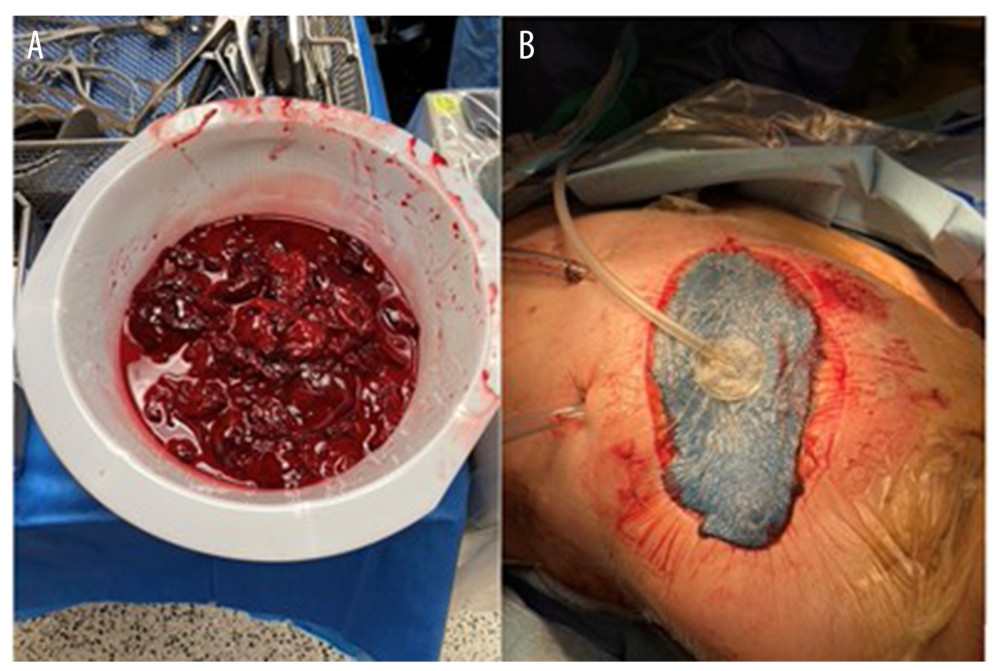 (A) Upon entry into the chest approximately 2 liters of clotted blood was encountered. (B) Modified ABTHERA ADVANCE™ Open Abdomen Dressing and left thoracostomy tubes placed for temporary chest closure.