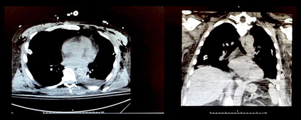 Post-operative CT angiogram of the chest was performed 24 hours after negative-pressure wound therapy and damage control therapy revealed no active arterial extravasation.