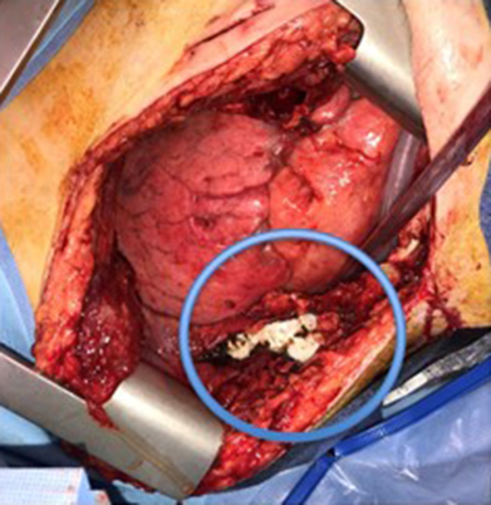 An intercostal artery at the left fourth rib fracture was noted to have active bleeding. This was ligated and packed with oxidized cellulose (circle).