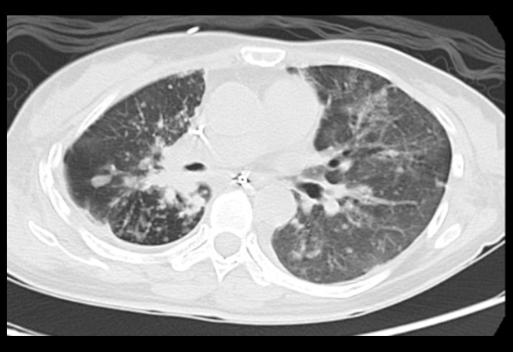 CT scan showed completely resolved bilateral ground-glass opacities and consolidation.