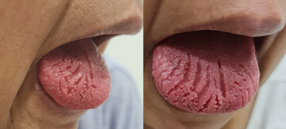 (A, B) Glossitis with fissuring of the tongue due to an adverse event following immunization with BNT162b2.