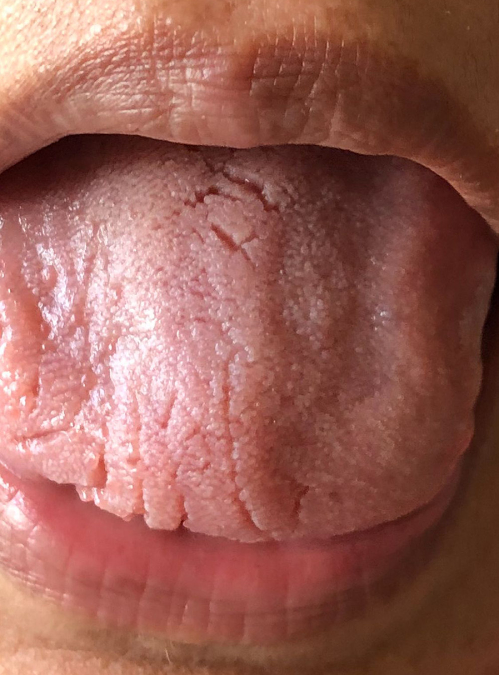 Resolution of glossitis due to an adverse event following immunization with BNT162b2, following tapered dosing of topical corticosteroid therapy.