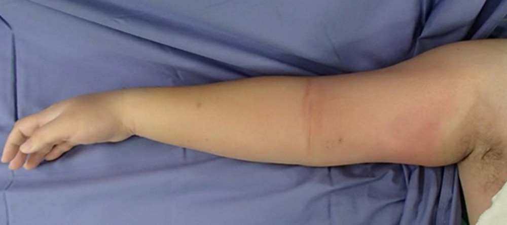 Photograph of the patient’s right arm showing swelling and redness of the right upper arm without blistering.