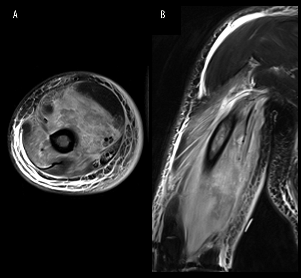Fat-suppressed T2-weighted magnetic resonance imaging showed diffuse heterogeneous high signal intensity in the biceps brachii, brachialis, and triceps brachii muscles. Axial (A) and coronal (B) images of the right upper arm.