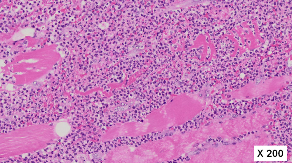 Histological examination of the affected muscles revealed marked infiltration of polymorphonuclear leukocytes (hematoxylin and eosin stain).