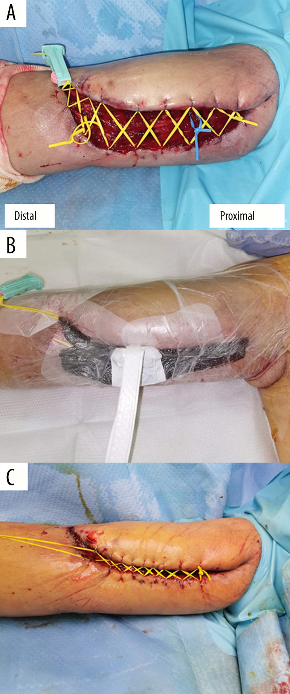 (A) The shoe-lace technique with vessel tape was used for rapid wound closure, combined with negative-pressure wound therapy by using RENASYS TOUCH™ (Smith & Nephew, Hull, UK) for decreasing edema and granulation (B) (day 28). (C) The appearance of the wound on day 41 (day 0 was the day the peripherally inserted central catheter was inserted).