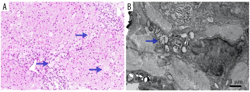 (A) Liver biopsy showing clusters of enlarged histyocites with foamy cytoplasm (Niemann-Pick cells) both in hepatic lobules and portal tracts. (B) Electron micrograph showing concentric myelin-like inclusions and laminated zebra bodies in Kupffer cells.