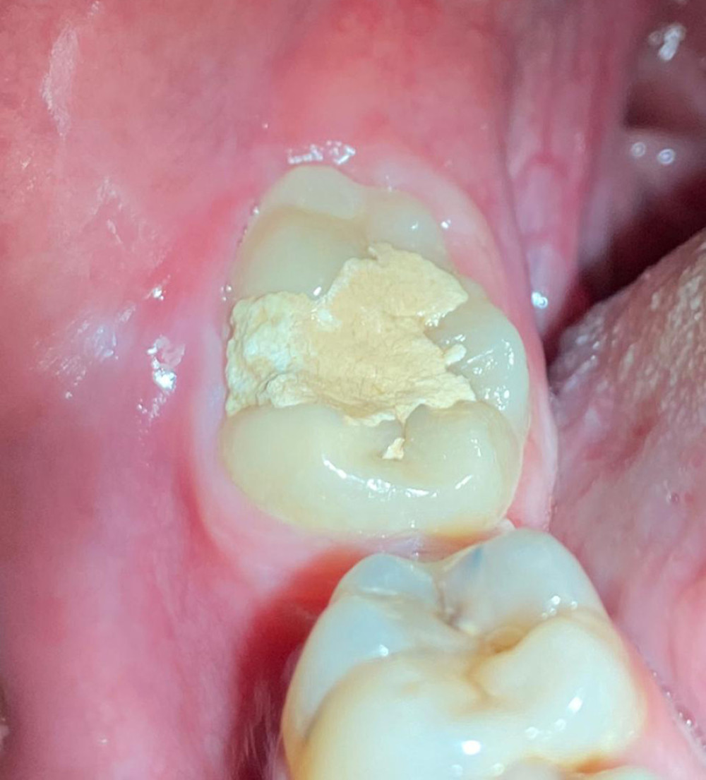 Intraoral picture shows a large, mesially tilted, irregular third molar fused with the fourth molar and temporary filling covering the occlusal and buccal surface.