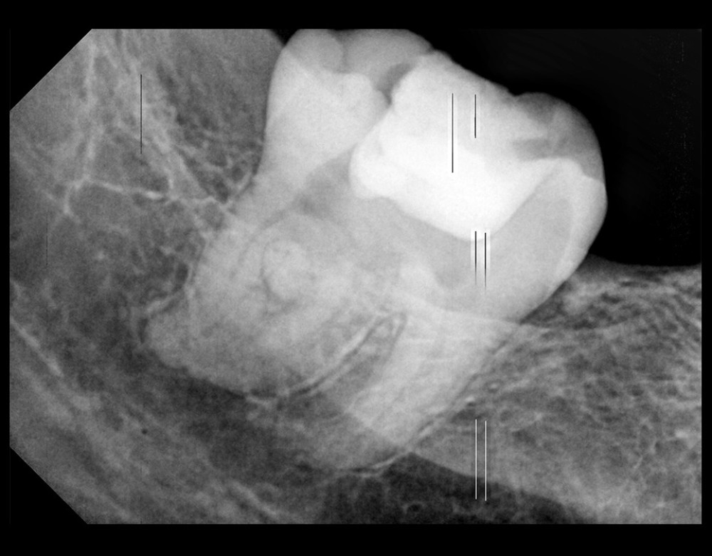 An intraoral periapical radiograph of the lower right mandibular area revealed a fused third molar and supernumerary tooth with an irregular morphology and a wide mesiodistal width. Radiopacity seen in the furcation area appeared to be the enamel pearl.