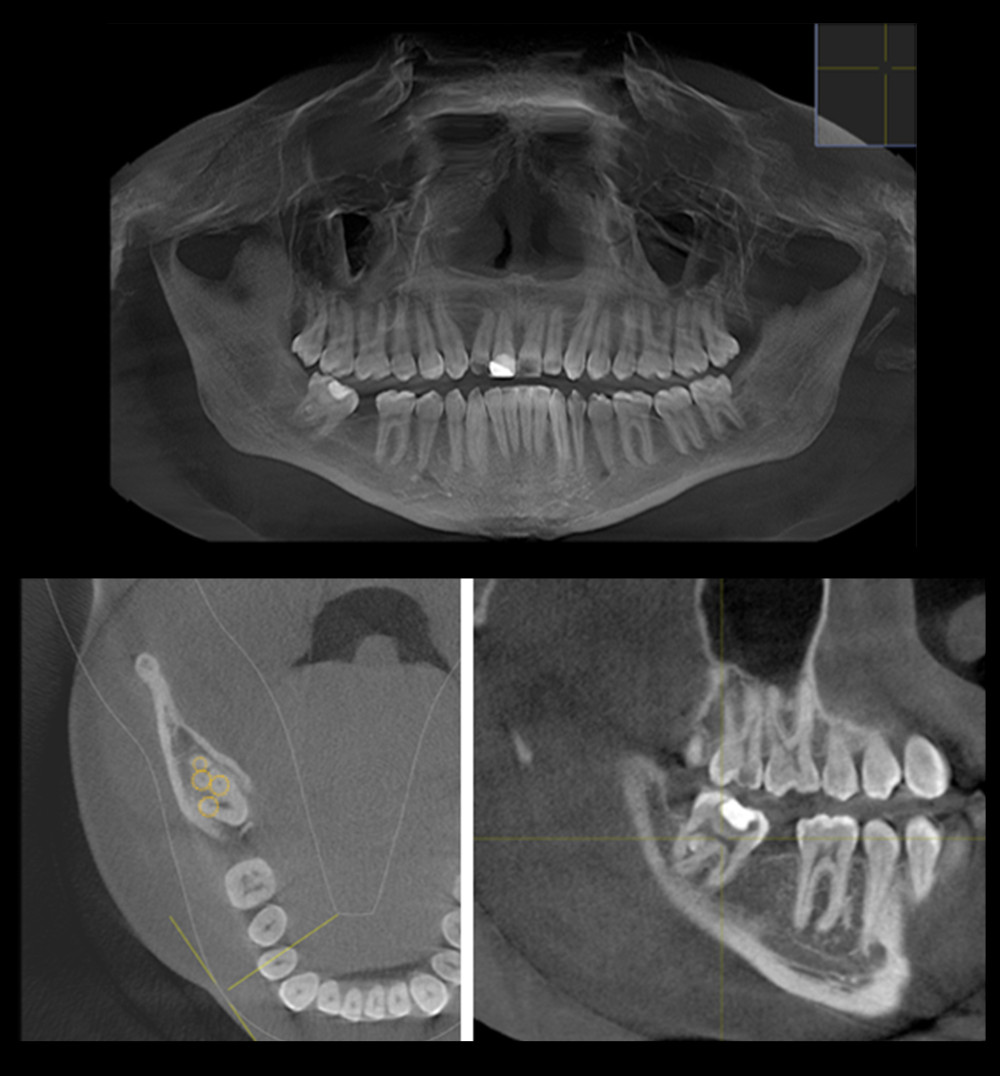 Multiple cone beam computed tomography slices revealed the unilateral fused third with continuous pulp chamber, and the number of canals was 5 in the axial view.