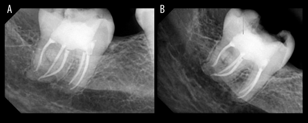Intraoral periapical radiographs showing (A) a postoperative radiograph of fused third molar with supernumerary tooth and (B) a 6-month follow-up radiograph showing normal bone appearance.