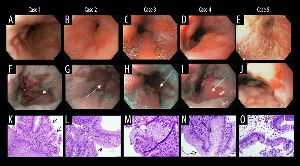 Endoscopic and histopathological findings. A–E, J: White light illumination of the distal esophagus in case 1 (A), 2 (B), 3 (C), 4 (D), 5 (E, J); F–I: Narrow band imaging of the distal esophagus in case 1 (F), 2 (G), 3 (H), 4 (I), accentuating the abnormal (columnar) mucosa (white arrows); K–O: Distal esophageal histology in case 1 (K), 2 (L), 3 (M), 4 (N), 5 (O), showing goblet cell mimickers (black arrows) in cases 1, 2, 4 or goblet cells (black stars) in cases 3 and 5.