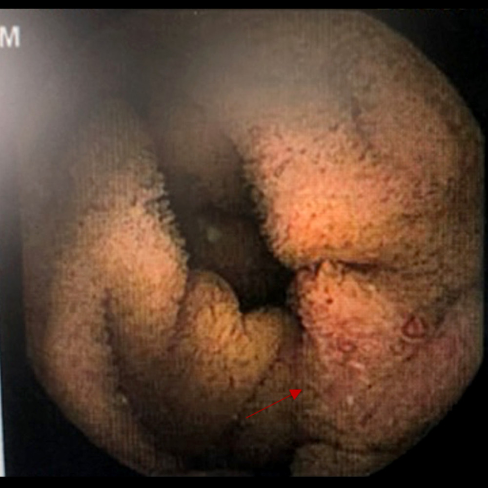 Video Capsule endoscopy. Small erythematous lesion without active bleeding (see arrow).