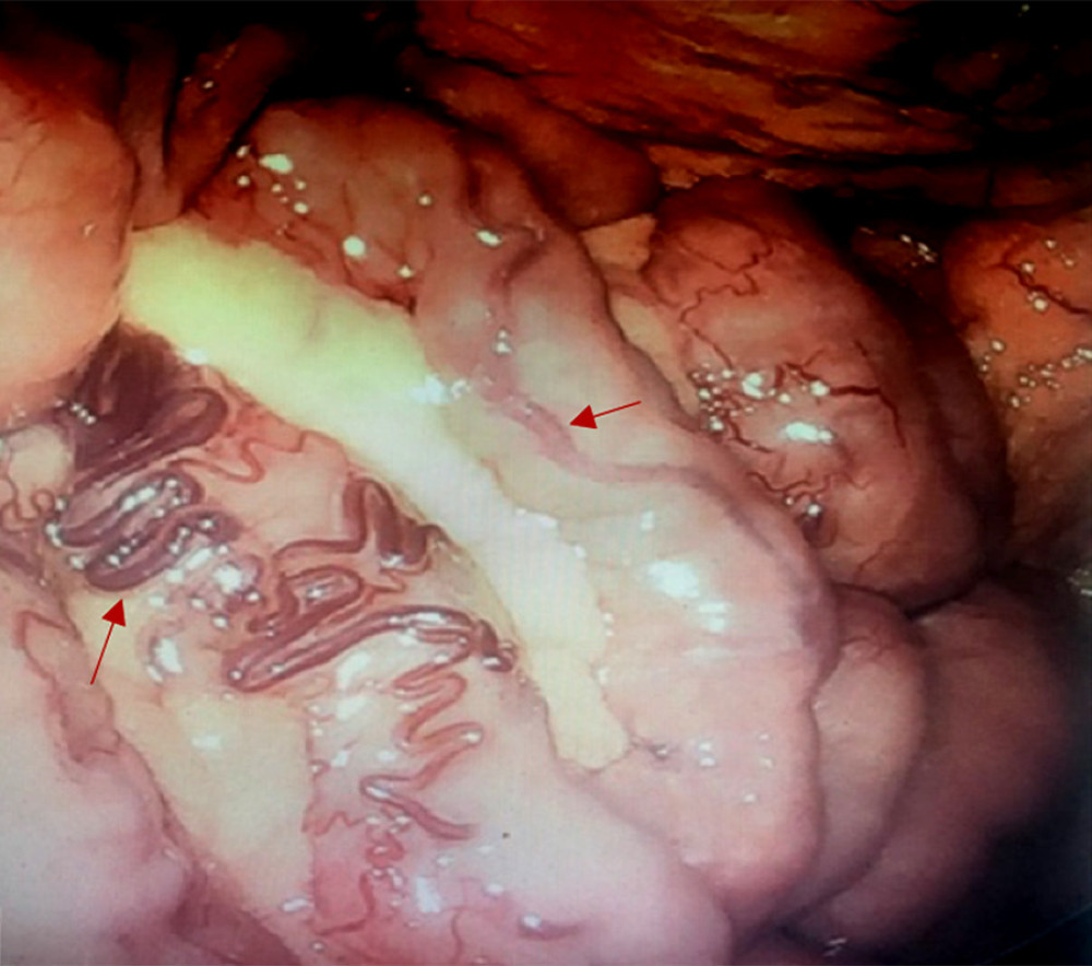 Surgically assisted push enteroscopy. External examination of the bowel with prominent, dilated, tortuous, diffuse intestinal surface blood vessels throughout the antimesenteric region of the small bowel (arrows).