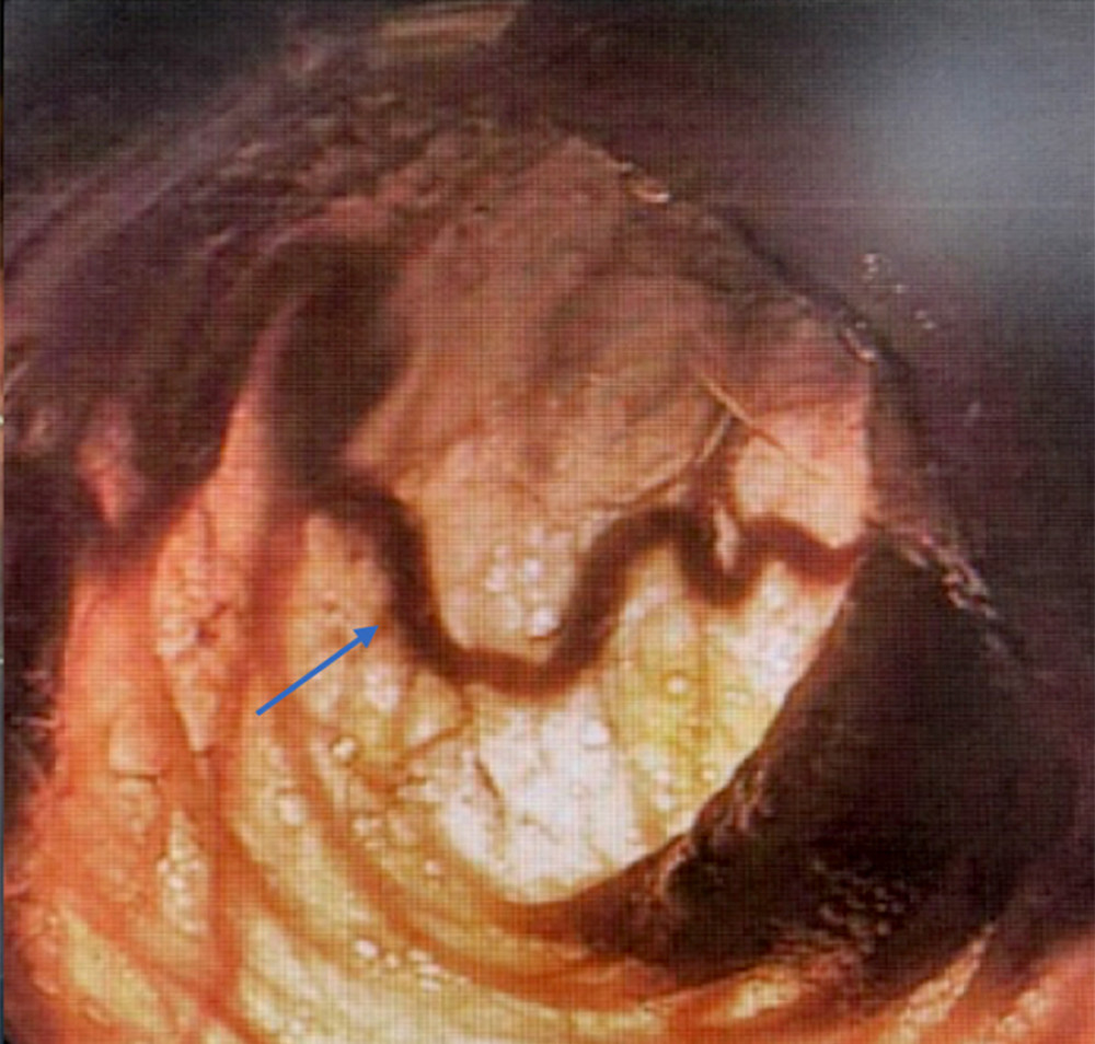 Surgically Assisted Push Enteroscopy. Endoscopic transillumination demonstrated prominent, dilated, tortuous, diffuse intestinal blood vessels in the small bowel (arrow).