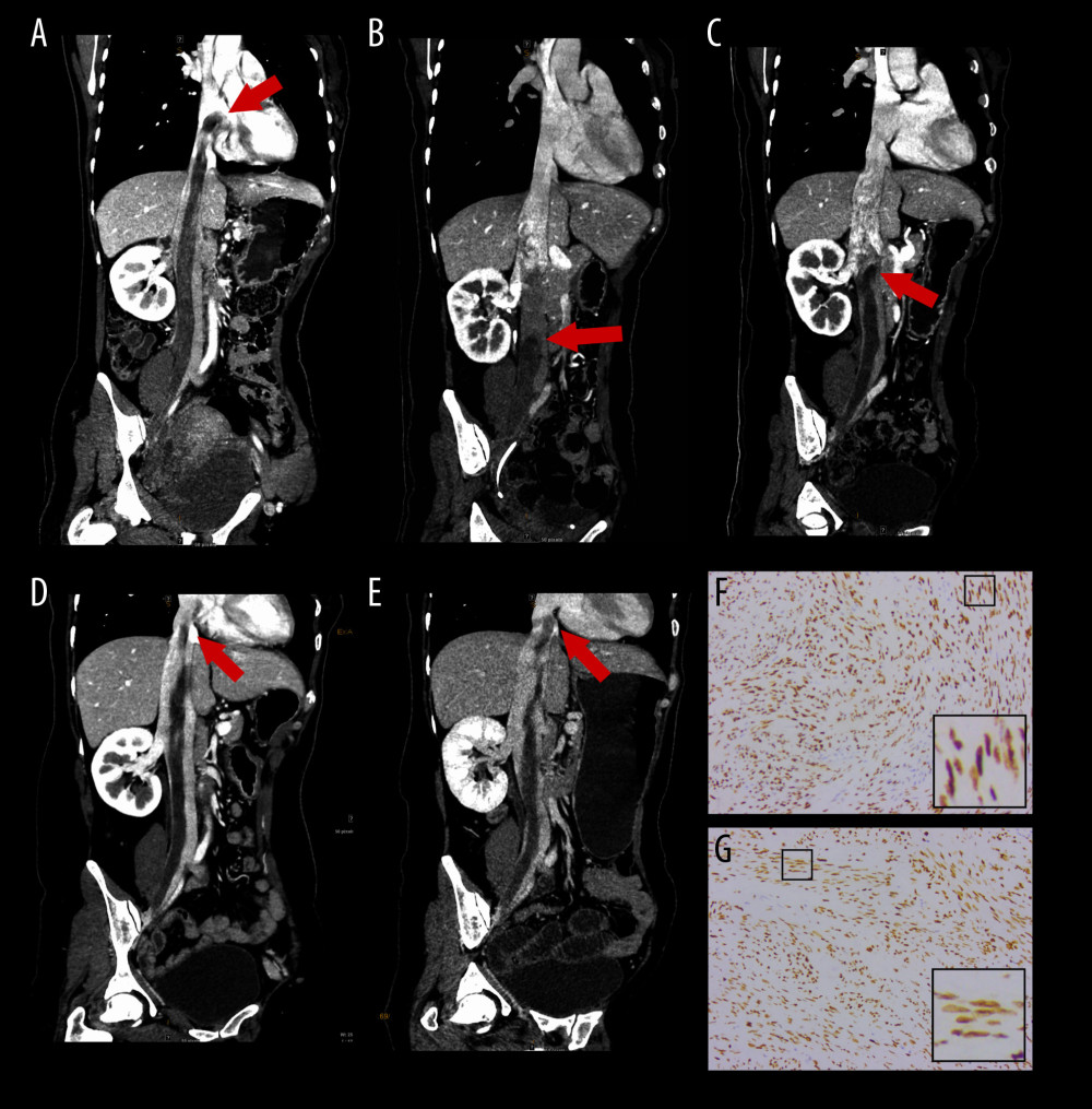 (A–E) Coronal slices of CECT images of the ICLM, taken preoperatively and postoperatively. (A) Preoperatively, the proximal end of the ICLM was located inside the right atrium at the level of T81. (B) Two weeks after BSO, the leiomyoma had shrunk dramatically, and the proximal end was located inside the IVC at the level of L32. (C) At 70 weeks after BSO, the leiomyoma had spread slowly, its proximal end being located inside the IVC at the level of L12. (D) At 119 weeks after BSO, the proximal end of the leiomyoma was located inside the IVC at the level of T101. (E) At 190 weeks after BSO, the proximal end was still located inside the IVC at the level of T101. (F, G) The expression of estrogen (ER) and progesterone (PR) were tested by immunohistochemistry. Immunohistochemical staining showed that the nuclei of smooth muscle cells were (F) 85% ER+ and (G) 70% PR+. 1 – thoracic vertebrae; 2 – lumbar vertebrae. BSO – bilateral salpingo-oophorectomy; CECT – contrast-enhanced computed tomography; ICLM – intracardiac leiomyomatosis; IVC – inferior vena cava.