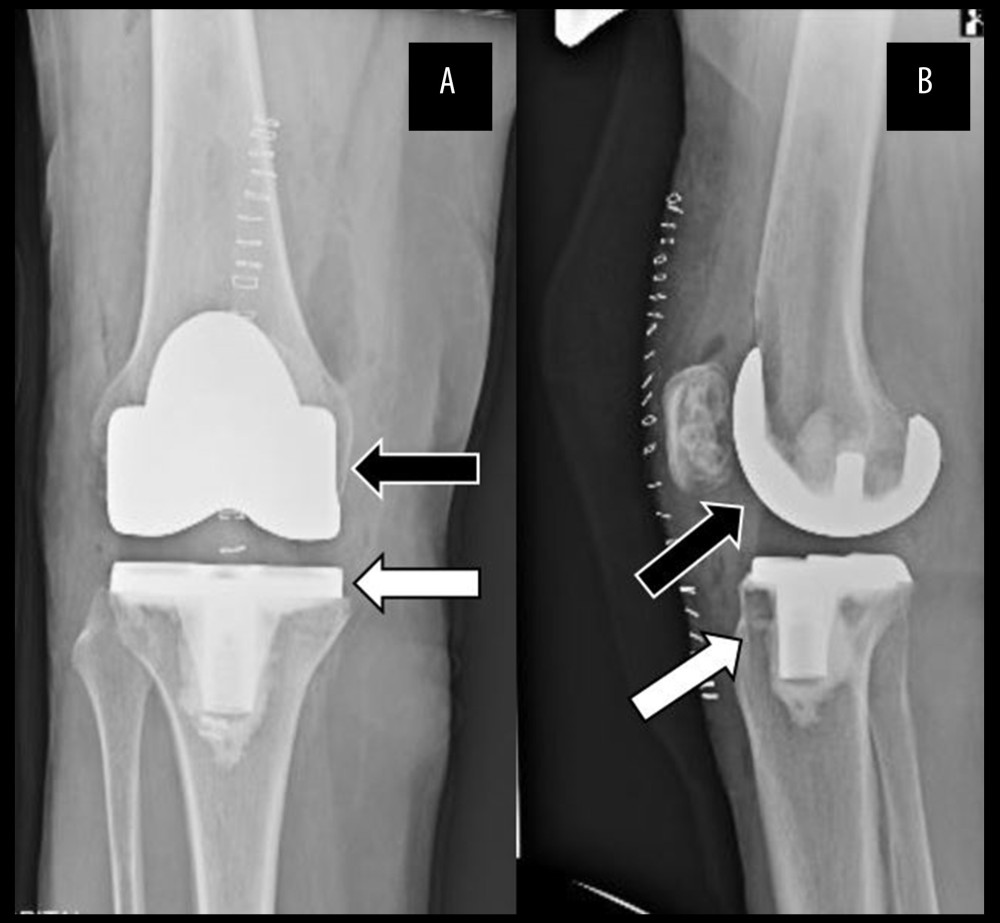 Anteroposterior (A) and lateral (B) radiographs of the right knee status after the index procedure, demonstrating the cemented total knee arthroplasty in appropriate alignment without evidence of acute osseous abnormalities. The dark arrows indicate the femur and femoral component, while the light arrows indicate the tibia and tibial component.