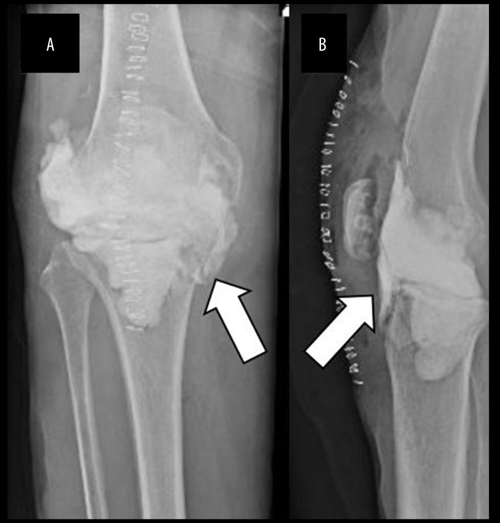 Anteroposterior (A) and lateral (B) radiographs of the right knee status after implant removal, thorough irrigation and debridement, synovectomy, and placement of a static antibiotic spacer consisting of 2 batches of antibiotic-laden cement with 6 g of vancomycin and 4.8 g of tobramycin. The light arrows highlight the cement spacer, which was placed intra-articularly between the distal femur and proximal tibia.