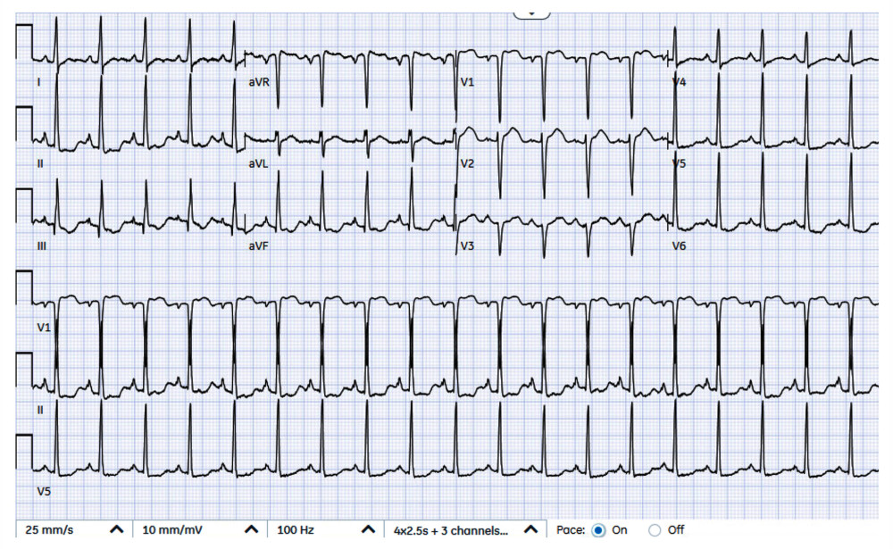 Electrocardiogram showing sinus tachycardia (115 bpm), with right atrial enlargement, and left ventricular hypertrophy with repolarization changes (according to the Sokolow-Lyon criteria).
