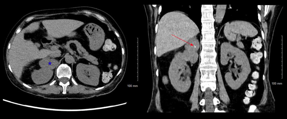 Computed tomography (CT) abdomen with adrenal protocol showing a 45×37×46 mm mass in the right adrenal gland (see blue star), measuring 38 Hounsfield units (Hu) on precontrast imaging, 68 Hu at 90-s delay, and 98 Hu at 10-min delay. The mass contained several calcifications (see red arrow), suggesting degeneration or necrosis.
