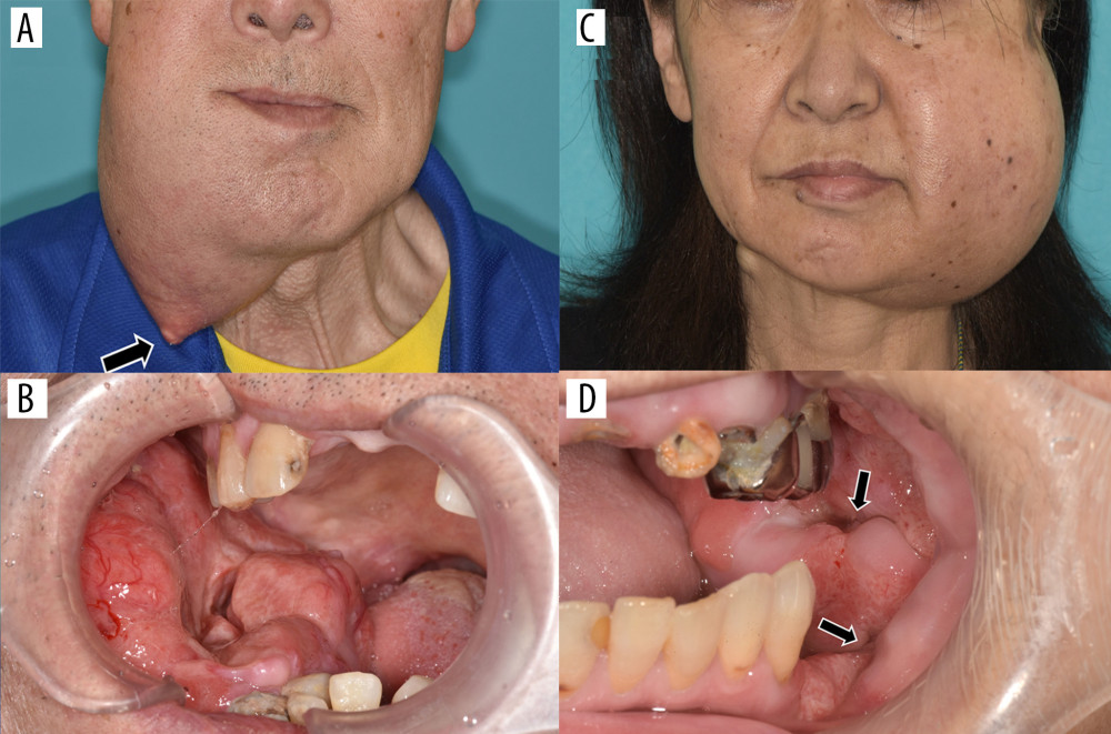 (A) Facial photograph of the patient in case 1. Significant swelling is found in the right mandible. An arrow indicates a fistula. (B) Intraoral photograph of the patient in case 1. The lesion growth is observed around the right mandibular gingiva. (C) Facial photograph of the patient in case 2. Significant swelling is found in the left mandible. (D) Intraoral photograph of the patient in case 2. Drainage of abscess is found from some fistulas of the intraoral lesion. Arrows indicate fistulas.