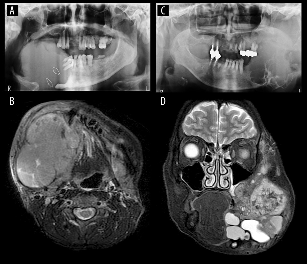 (A) Pantomography of the patient in case 1. The right mandible is absorbed by the tumor. There are wires used in past surgery. (B) T2-weighted magnetic resonance imaging (MRI) of the horizontal section of the patient in case 1. It confirms a large mass, including a multicystic region. (C) Pantomography of the patient in case 2. The left mandible is absorbed by the tumor. (D) T2-weighted MRI of the coronal section of the patient in case 2. The tumor expands to the left temporomandibular region from the mandible.