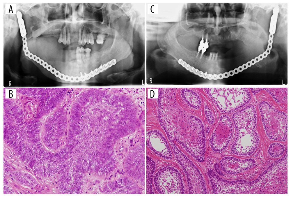 (A) Pantomography of the patient in case 1 at 6 months after surgery. The tumor was resected, and the mandibular shape was reconstructed using a titanium plate with the condyle head. (B) Pathological photograph of the patient in case 1. Tumor nests showing densely packed cells rimmed by tall columnar cells with marked pleomorphism (×200, H–E stain). (C) Pantomography of the patient in case 2 at 6 weeks after surgery. The tumor was resected, and the mandibular shape was reconstructed using a titanium plate with the condyle head. (D) Pathological photograph of the patient in case 2. Tumor consisting of various-sized and -shaped follicular parenchyma, dense collagenous stroma, and granular cells in central areas of the tumor nests (×100, H–E stain).