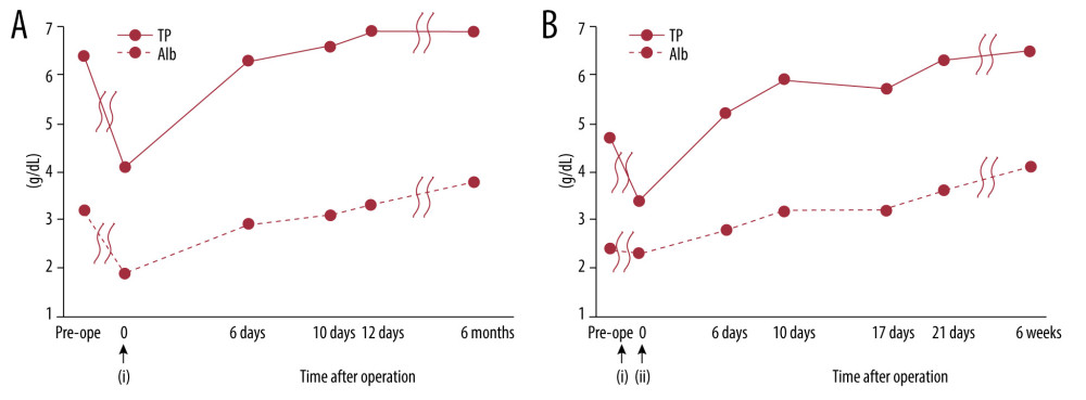 The progress records of total protein and albumin levels. (A) Case 1. Total protein and albumin levels increased moderately after their decrease due to surgery and increased 6 months after surgery compared to before surgery. (i): Transfusion of 4 units of red cell concentrate mannitol adenine phosphate (RC-MAP) during surgery. (B) Case 2. Total protein and albumin levels increased after their decrease due to surgery and increased significantly 6 weeks after surgery compared to before surgery. (i): Transfusion of 4 units of RC-MAP and intravenous injection of 2 vials of 5% Albuminar® before surgery. (ii): Transfusion of 10 units of RC-MAP and 6 units of fresh-frozen plasma and intravenous injection of 2 vials of 5% Albuminar® during and after surgery.