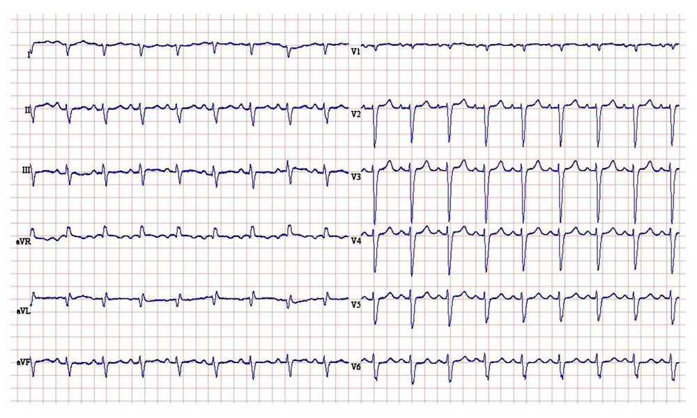 Baseline ECG. ECG shows a sinus tachycardia with normal AV conduction (PR interval 162 ms) and broad QRS complex (116 ms), suggesting an intraventricular conduction delay. The extreme axis deviation (223 degrees), the dominant S-waves in leads I, II, and III (“S1S2S3 pattern”), and the deep S-waves in leads V5 and V6 are consistent with RV disease.