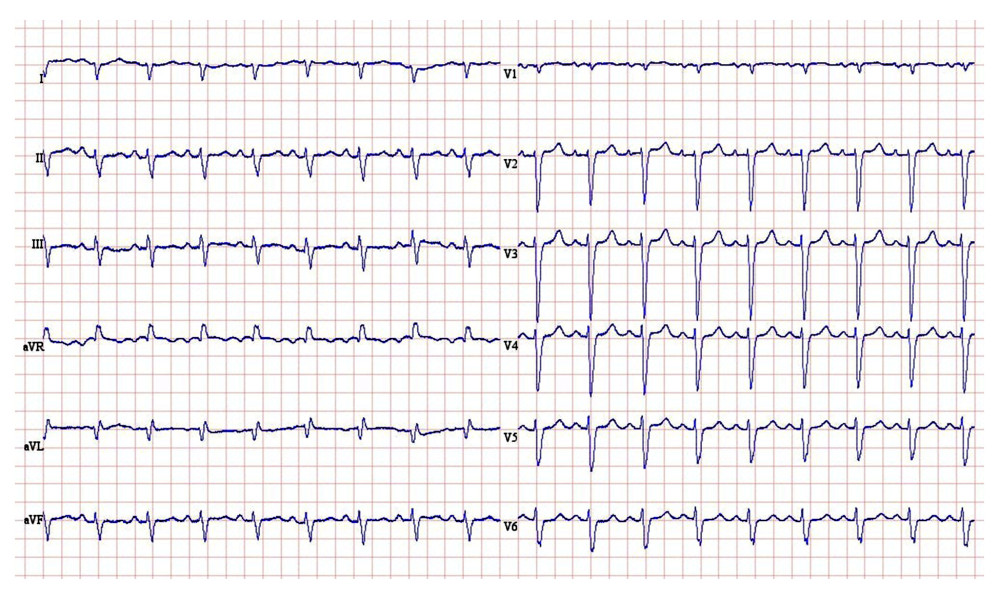 Baseline ECG. ECG shows a sinus tachycardia with normal AV conduction (PR interval 162 ms) and broad QRS complex (116 ms), suggesting an intraventricular conduction delay. The extreme axis deviation (223 degrees), the dominant S-waves in leads I, II, and III (“S1S2S3 pattern”), and the deep S-waves in leads V5 and V6 are consistent with RV disease.