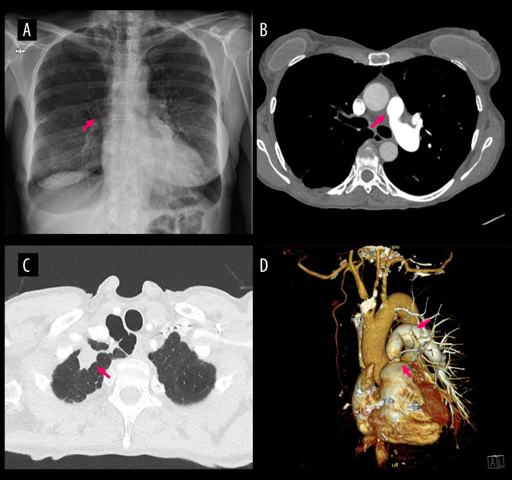 Radiological findings. (A) Arrow shows the hypoplastic aspect of the right lung hilum on chest X-ray. (B) Arrow shows absent right PA. (C) Arrow shows a spiculated mass in the right upper lobe. (D) 3D volume-rendering reconstruction showing RVOT obstruction and solitary left PA.