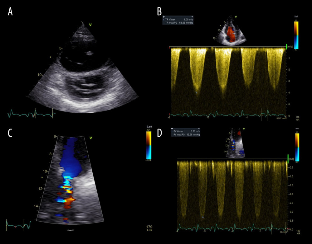 Transthoracic echocardiography on admission. (A) RV dilatation and D-shaped interventricular septum during diastole, consistent with RV volume overload. (B) Severe tricuspid regurgitation with TR gradient of 64 mmHg. 2D vena contracta was 7.6 mm and hepatic vein systolic flow reversal was present. RA pressure was 10–20 mmHg. (C) Flow acceleration at the level of the pulmonary valve. (D) Moderately increased peak transpulmonary gradient of 44 mmHg. Subtracting the gradient across the pulmonary valve from RV systolic pressure yields the PA systolic pressure. In this case, the calculated PA systolic pressure is 30–40 mmHg.