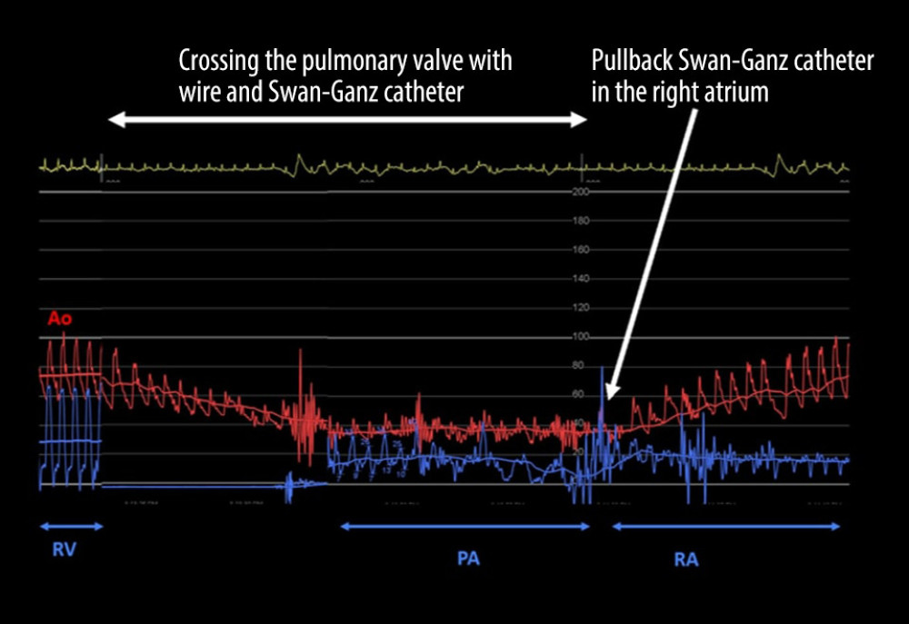 Baseline hemodynamic data during right-heart catheterization. Aorta (Ao), right ventricle (RV), pulmonary artery (PA), and right atrium (RA) pressure tracings. Note the clear fall in systemic pressure when crossing the pulmonary valve and subsequent pressure recovery after catheter pullback. This can be explained by mechanical obstruction of a narrowed pulmonary orifice and relief of this obstruction after catheter withdrawal. This is similar to Carabello’s sign in critical aortic stenosis.
