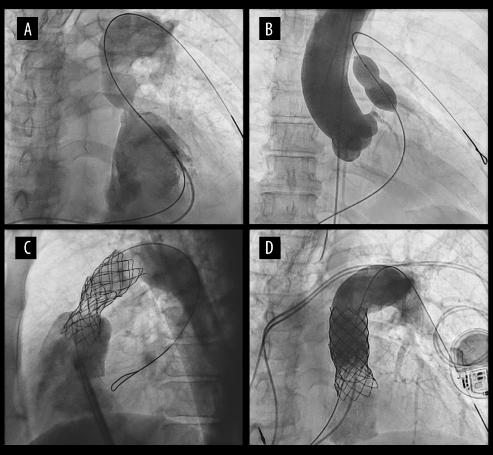 Percutaneous pulmonary valve implantation (PPVI). (A) Valvular RVOT obstruction and a single left PA. (B) RVOT balloon inflation (Tyshak II PDC 523 17.0×33 catheter) with simultaneous aortic root angiography (Pigtail 5 French catheter) to exclude coronary artery compression. (C) Three stents deployed in the RVOT with consequent free pulmonic regurgitation, visible as reflux of contrast into the RV. Two Covered 8 Z 45 stents and 1 Optimus AT 43 XL stent premounted on BIB BB 10 and 11 French catheters were used. The stents were placed in a diabolo configuration to limit diastolic backflow. Post-dilatation of the first stent with a PTS 306 30.0×30 8 French catheter. (D) Angiography after 23 mm Edwards SAPIEN 3 valve implantation shows competent valve function.