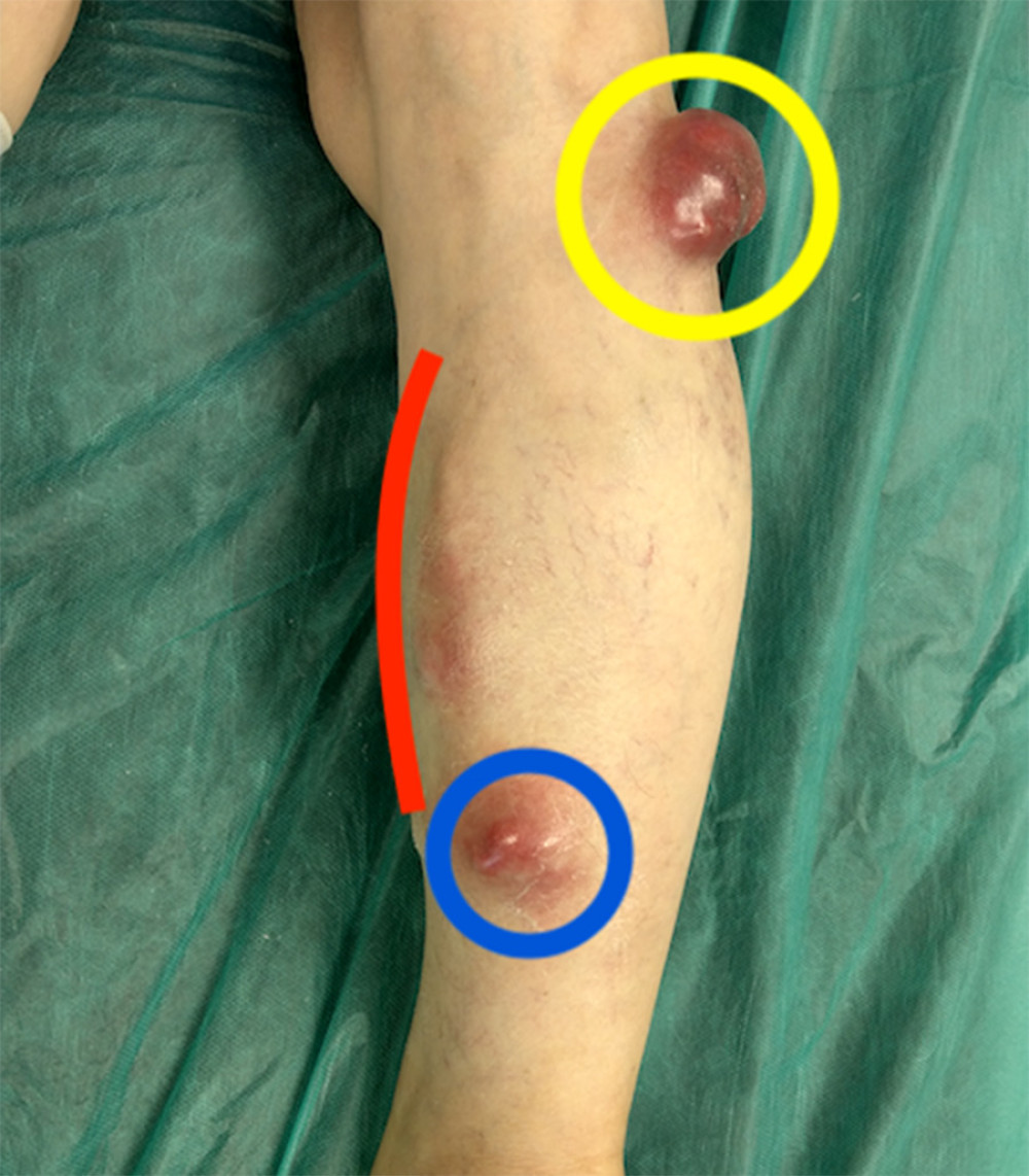 The red line indicates inflammatory GSV. The yellow circle shows the tumor close to the popliteal fossa. The blue circle indicates the tumor under the ankle.