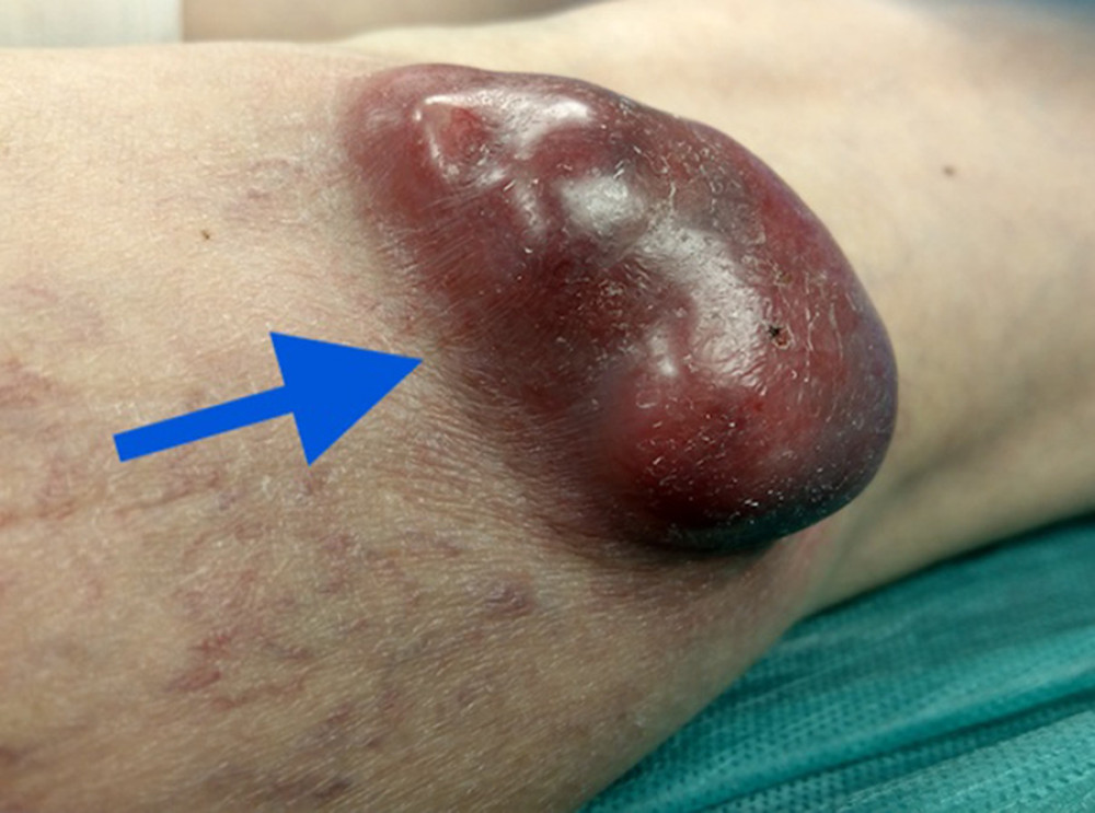 The blue arrow points to the tumor at the entrance to the popliteal fossa.