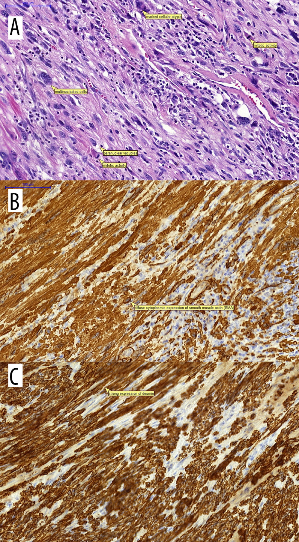 Histopathologic evaluation. (A) Leiomyosarcoma (hematoxylin and eosin staining), in which tumor cells exhibit nuclear atypia with hyperchromatic nuclei and prominent nucleoli. Original magnification ×20. (B) Immunohistochemical staining of smooth-muscle actin (SMA). Original magnification ×20. (C) Immunohistochemical staining of desmin. Original magnification ×20.