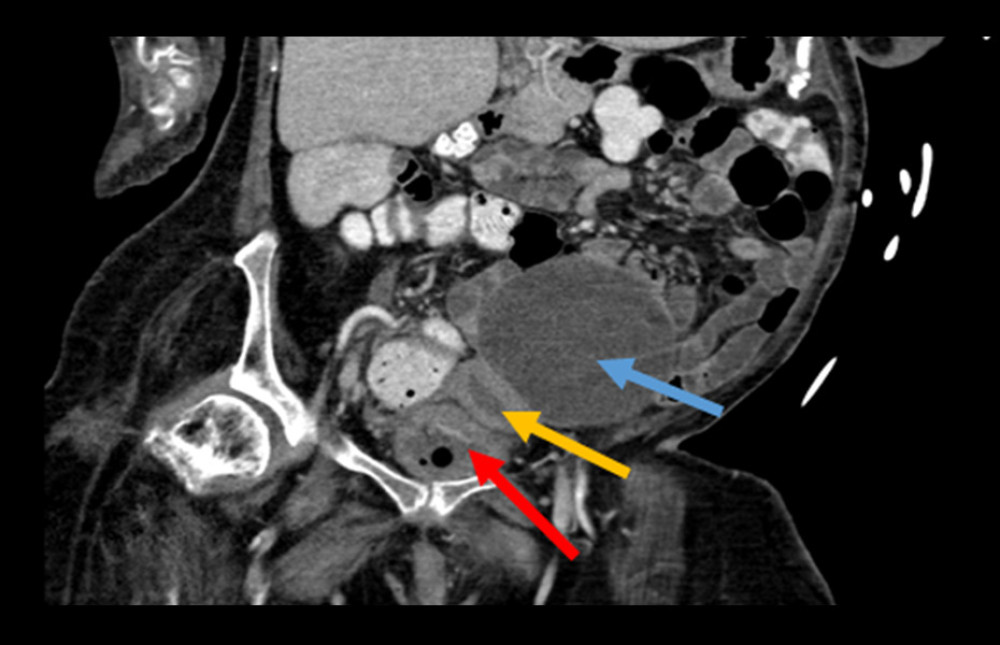 Computed tomography (CT), illustrating a huge (9.5×7.7 cm) ovarian cyst placed to the left (blue arrow) and behind a fluid-containing uterus (yellow arrow) and a drained bladder (red arrow). The large, round filling defect within the bladder represents an air bubble within the inflated balloon of a Foley catheter.