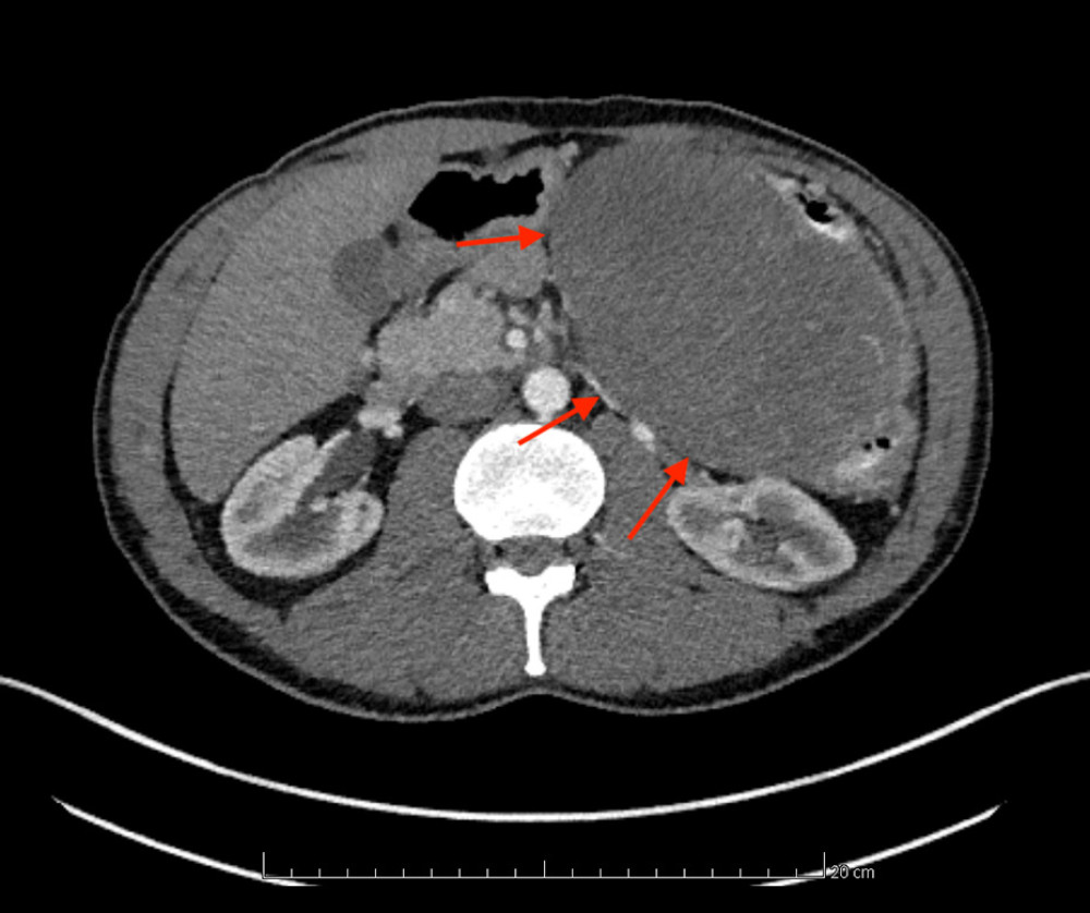 CT scan with contrast in arterial phase showing the DT in the left hypochondrium bulging from the pancreas; axial view. Red arrows indicates the tumor mass.