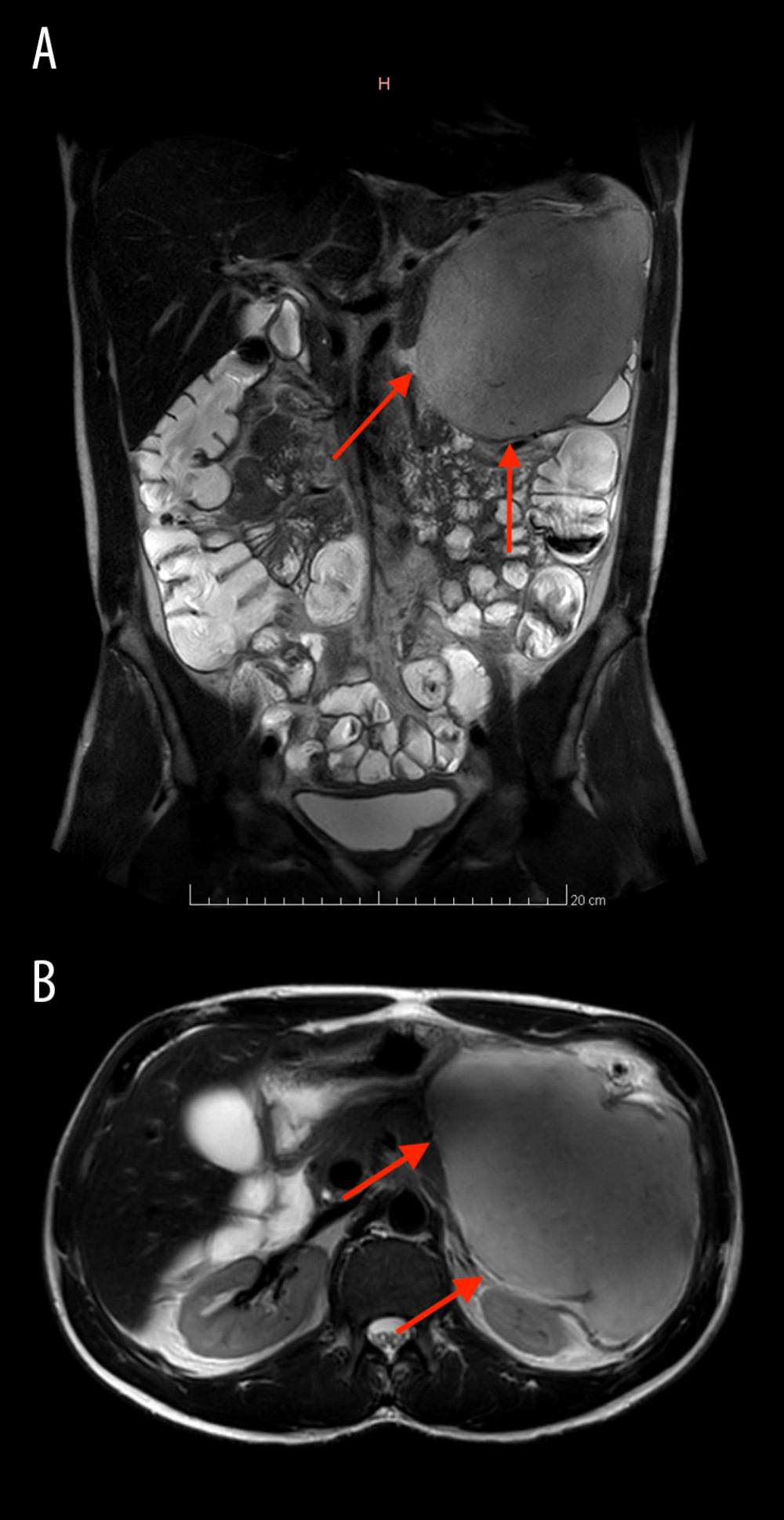 First MRI images in T2 sequence showing the pancreatic mass compressing the left colic flexure. Red arrows indicates the tumor. (A) Frontal view. (B) Axial view.