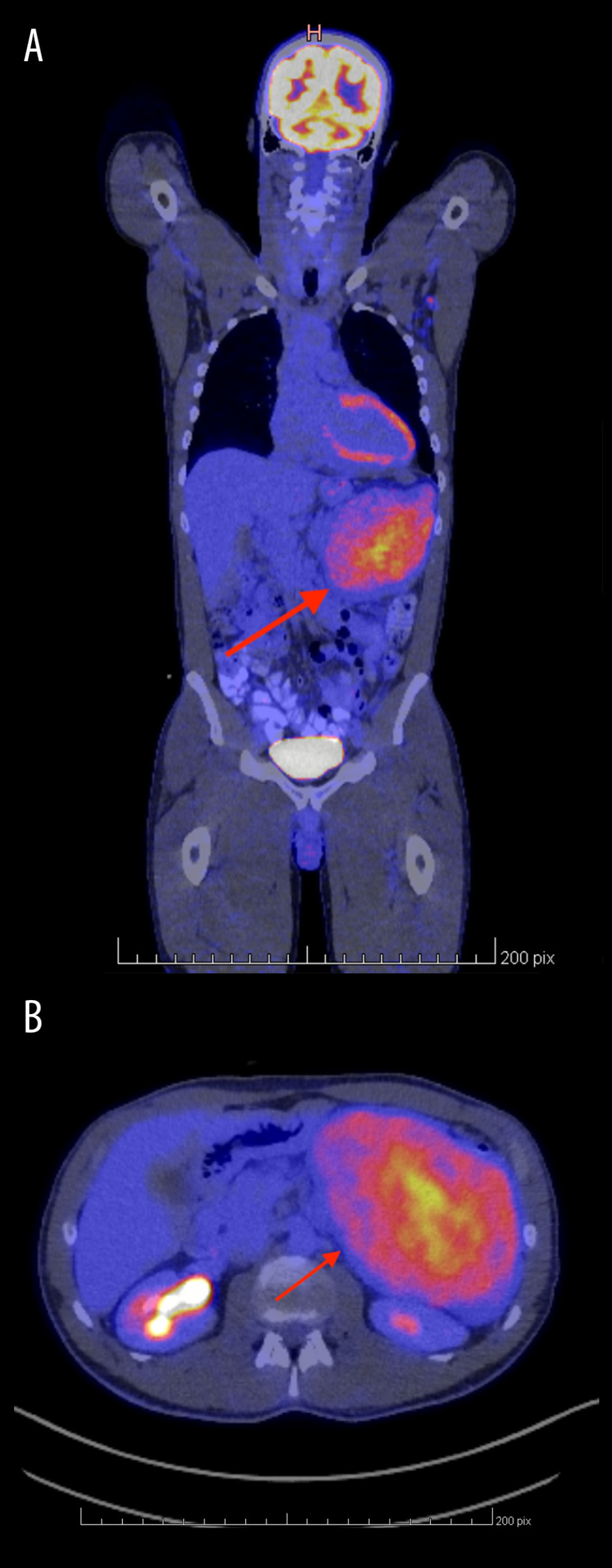 PET/CT scan showing hypermetabolic signal of the pancreatic mass and absence of secondary tumors. Red arrows indicate the hypermetabolic tumor. (A) Frontal view. (B) Axial view.