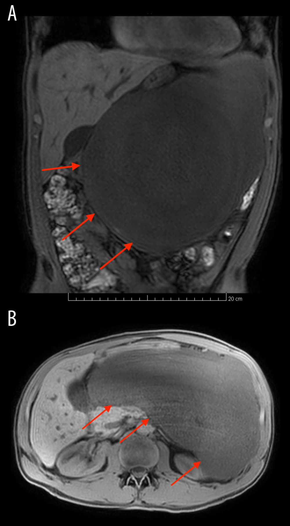 Second MRI image showing the expansion of the pancreatic mass. (A) Frontal view in T1 sequence. (B) Axial view contrast enhancement.