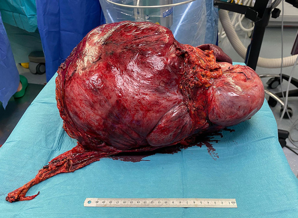 Intraoperative picture of the resected tumor.