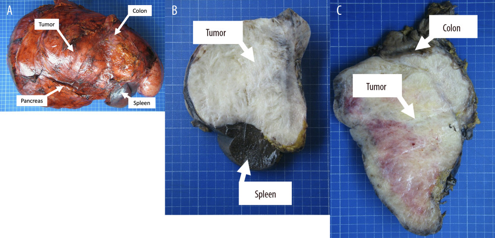 Macroscopy of the resected tumor. (A) Resected tissue weighing 7.057 g, consisting of a large tumor measuring 40×31 cm and a spleen segment measuring 12×10 cm, a colonic segment measuring 25×3 cm, and a pancreatic segment measuring 25×3 cm. (B, C). The mass protruding through the colonic wall.