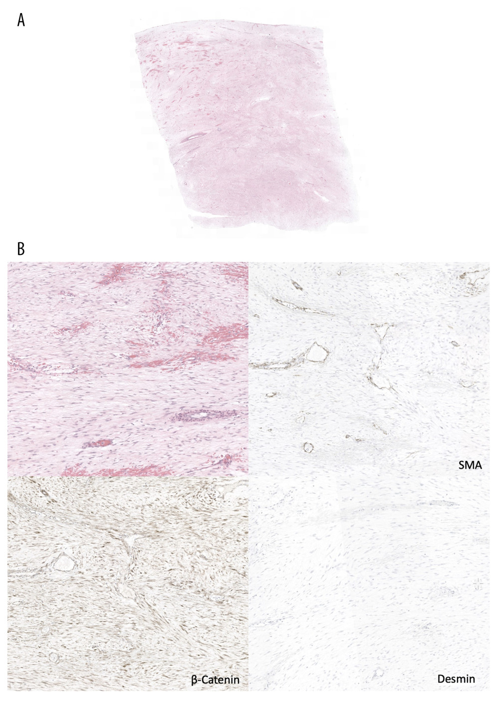 Histology findings. (A) Elongated, thin, and tapered cells of uniform appearance with pale cytoplasm and embedded in a collagenous stroma. No nuclear hyperchromasia, cytological atypia, or mitosis. Blood vessels are thin-walled with perivascular edema and vascular microhemorrhages. (B) Nuclear β-catenin staining is observed. Smooth muscle actin (SMA) was weakly positive and desmin fixation was negative. DNA sequencing revealed that the CTNNB1 (β-catenin) gene carried the p.T41A (c.121A>G) mutation.