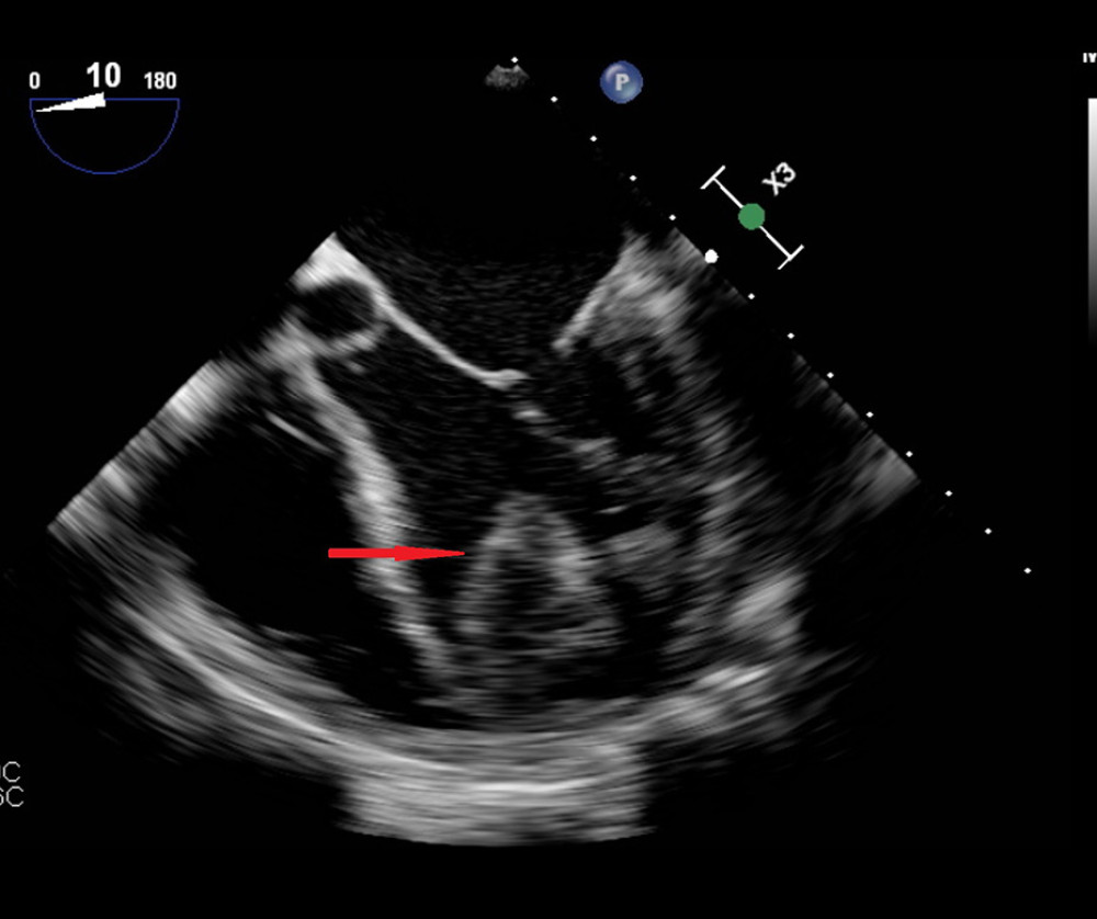 Echocardiographic assessment of LV thrombus localization: Illustration of a 4.5×4.2 cm thrombus localized in the apex of the left ventricle.