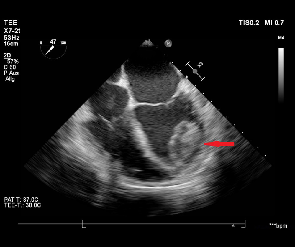 Thrombus adherence to LV wall: Apical 4-chamber view of the left ventricular thrombus with deep septal and trabecular position.
